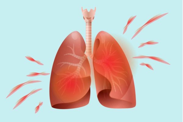 5 Cara Mengatasi Alergi yang Mempengaruhi Paru-paru Anda
