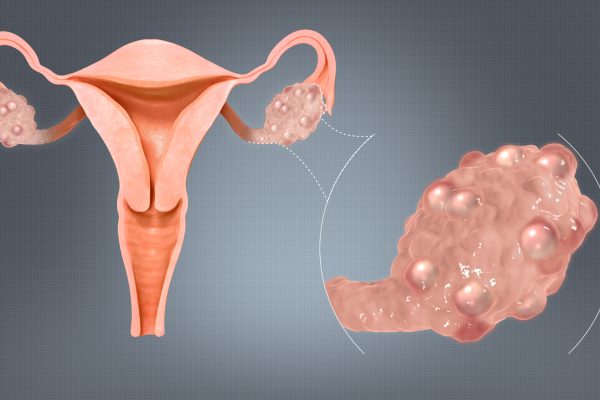 Cara Mencegah dan Mengatasi PCOS (Polycystic Ovary Syndrome)