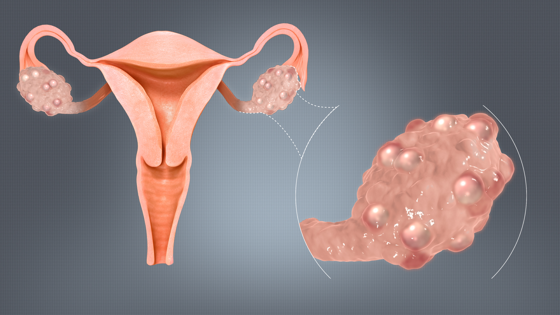 Cara Mencegah dan Mengatasi PCOS (Polycystic Ovary Syndrome)