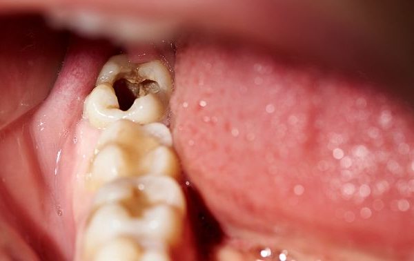 7 Cara Mengatasi Gigi Berlubang Tanpa Rasa Sakit