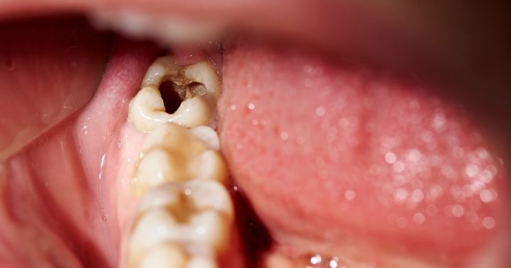 7 Cara Mengatasi Gigi Berlubang Tanpa Rasa Sakit