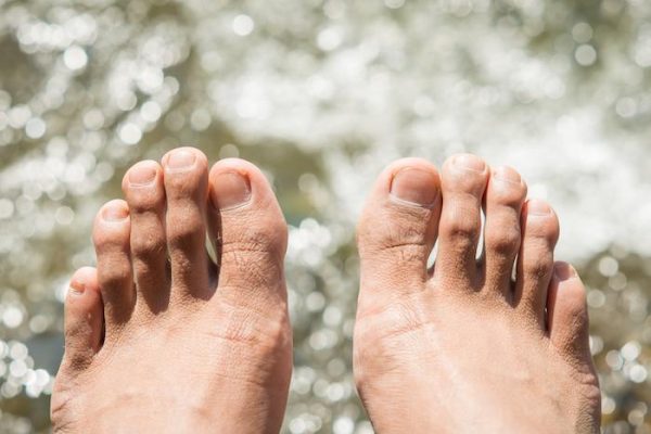 5 Cara Menghindari Infeksi Jamur di Kaki dan Jari