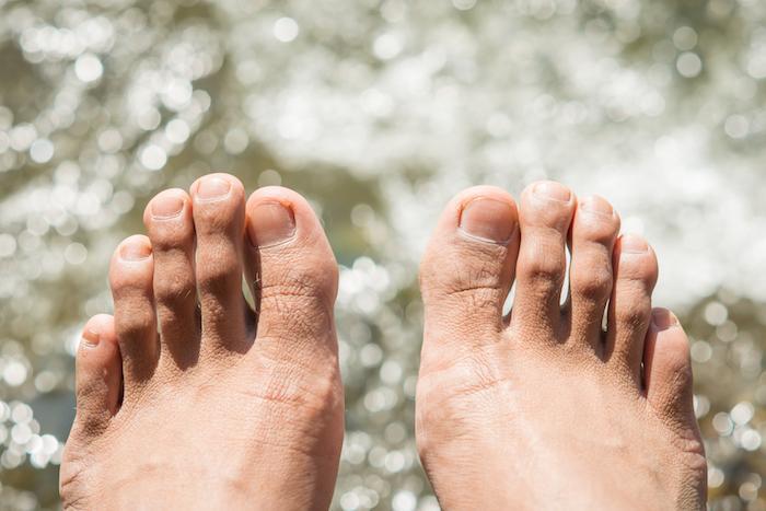 5 Cara Menghindari Infeksi Jamur di Kaki dan Jari