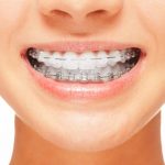 5 Cara Menjaga Gusi Tetap Sehat Saat Menggunakan Behel