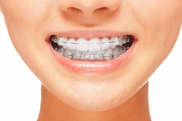 5 Cara Menjaga Gusi Tetap Sehat Saat Menggunakan Behel 5 Cara Menjaga Gusi Tetap Sehat Saat Menggunakan Behel
