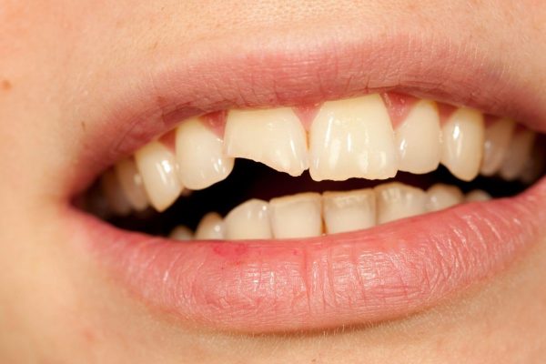 7 Cara Mencegah Gigi Retak atau Patah