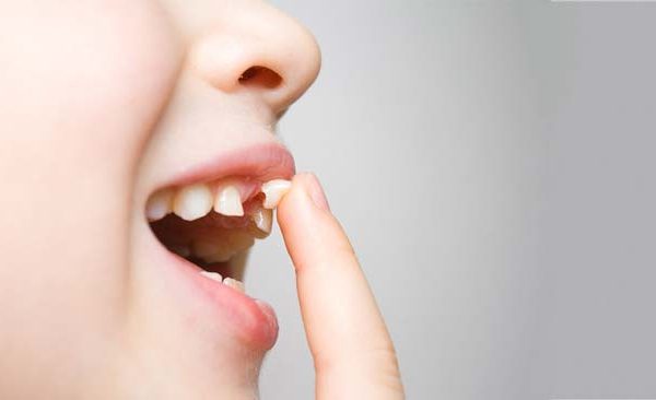 10 Tips Mengatasi Gigi Copot pada Orang Dewasa