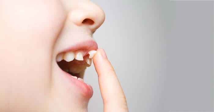 10 Tips Mengatasi Gigi Copot pada Orang Dewasa